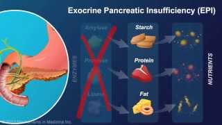 Exocrine Pancreatic Insufficiency [upl. by Godber]