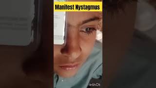 manifest Nystagmus  nystagmus eyediseases [upl. by Iel319]