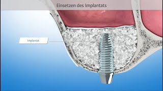 Sinuslift  Sinusbodenelevation 3DAnimation Zahnmedizin [upl. by Conrade]