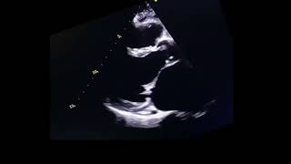 Mitral valve doming mitral stenosis echocardiography [upl. by Fryd]