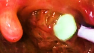 Tonsil Stones Tonsils Stone Popping and Stones in the Tonsils [upl. by Cirle]