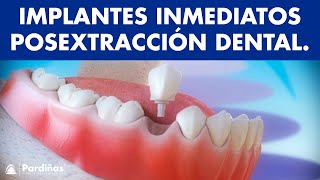 Implantes dentales inmediatos posextracción dental © [upl. by Icram]