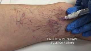 Clearing the Webs Understanding Sclerotherapy Spider Vein Injections [upl. by Ardnalac50]