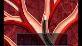 Airway Bypass Stenting for Severe Emphysema 1 [upl. by Fatima819]