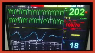 Taquicardia Supraventricular [upl. by Ayanal]