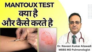 Mantoux Test क्या है और कैसे करते है  Mantoux tuberculin skin test TST TB Test  Diagnosis of TB [upl. by Wat195]