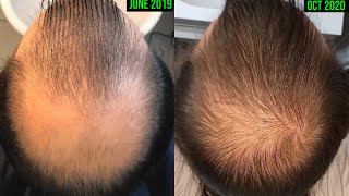 CRAZY MICRONEEDLING BEFOREAFTER RESULTS FOR HAIR GROWTH HAIR LOSS PREVENTION [upl. by Ong]