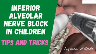 Inferior Alveolar Nerve Block in Children  tips and tricks  live [upl. by Argyle20]