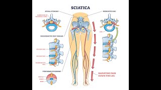 Ryggsmerter og spinal stenose [upl. by Theran]