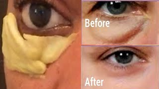 EASY REMEDY TO REMOVE EYE BAG AND PUFFY EYE FAST [upl. by Lennon]