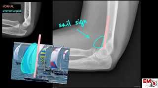 Elbow Xray Interpretation [upl. by Gifford595]