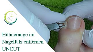 Hühnerauge im Nagelfalz entfernen Uncut [upl. by Nimrac]