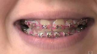 How Invisalign Attachments are placed [upl. by Enayr501]