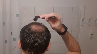 Minoxidil  Derma Roller Results I 4 Months Update [upl. by Plunkett]