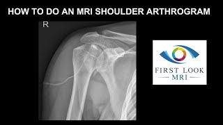 How to do an MRI shoulder arthrogram [upl. by Tteirrah59]