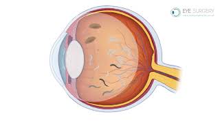 Floaters and Posterior Vitreous Detachment PVD [upl. by Waal]