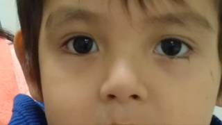 Nystagmus Video Pelizaeus Merzbacher [upl. by Secor]