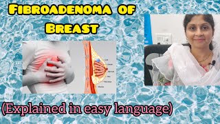 Fibroadenoma of Breast explained in simple language  Female Health  Treatment [upl. by Crowe]