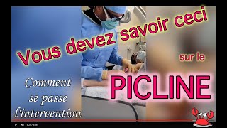 Pose de picline Lintervention en détail 🦀 CANCER DU SEIN [upl. by Floeter531]