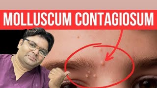 MOLLUSCUM CONTAGIOSUM REMOVAL 😱 [upl. by Asare717]