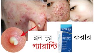 রাতে এই জেল লাগান সকালে ব্রন গায়েব হয়ে যাবে Differin Adapalene Gel  khadija begum  acne treatment [upl. by Jeremiah]