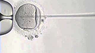 Intracytoplasmic Sperm Injection Procedure ICSI [upl. by Mihe]