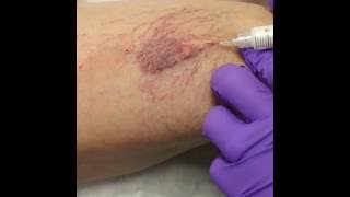 Sclerotherapy for Varicose amp Spider Veins at DermMedica [upl. by Remy]