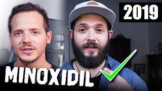 Minoxidil Bart 2019  Das Minoxidil Experiment 20 [upl. by Idram]