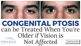 How Correcting Congenital Eyelid Ptosis can be Delayed as Long as Vision is Not Affected [upl. by Reidar]