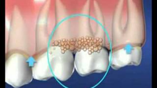 Dental Plaque [upl. by Linnette]