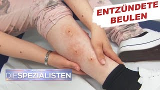 Beulen an den Beinen Parasitenbefall  Auf Streife  Die Spezialisten  SAT1 TV [upl. by Gates232]