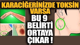 Karaciğerinizde Toksin Varsa Bu 9 Belirti Ortaya Çıkar [upl. by Jillie]