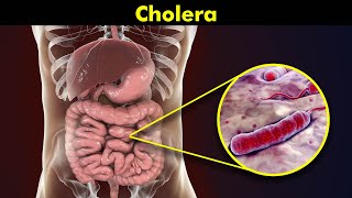 Cholera Causes Symptoms and Treatments [upl. by Saerdna981]