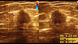 Breast Carcinoma  Fibroadenoma Breast  Benign Vs Malignant Breast Masses [upl. by Barrie759]