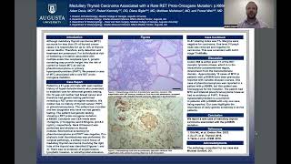 Medullary Thyroid Carcinoma Associated with a Rare RET ProtoOncogene Mutation pK666N [upl. by Ianthe826]