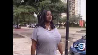 Biggest Natural Breasts in Texas – 36NNN Breast Reduction by Dr Franklin Rose [upl. by Notelrac]