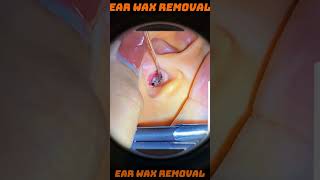 Ear Wax Removal 27 ears earwaxremoval asmr satisfying [upl. by Quenna]