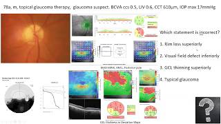 Lecture Using OCT as an Approach to Diagnose Glaucomatous and Other Optic Neuropathies [upl. by Hulbert]