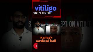 Vitiligo fact Nepali 2024 [upl. by Kaycee]