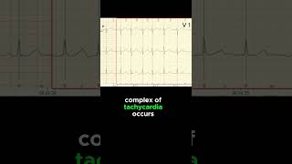 FOCAL ATRIAL TACHYCARDIA ECG EXAMPLE [upl. by Henri14]