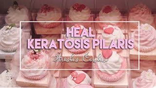 ♡ Heal Keratosis Pilaris ♡ [upl. by Anaiviv]