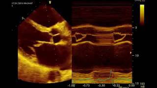 Insuffisance mitrale Sévère par rupture de cordagequotMitral Prolapsequot القصور التاجي الحاد [upl. by Yale408]