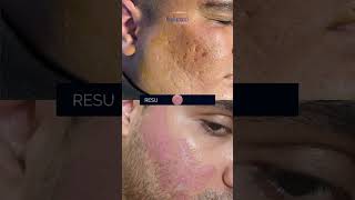 Dermabrasion  Noninvasive Procedure for Acne Scars  Dr Kamal [upl. by Gaillard]