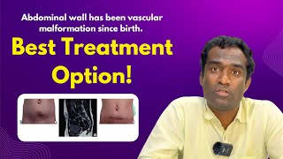 vascular malformation treatment in Hyderabad Dr Shaileshkumar at CitiVascularCentre  malformation [upl. by Tnert]