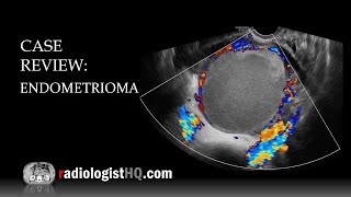 Case Review Ultrasound of Endometrioma [upl. by Eerb]