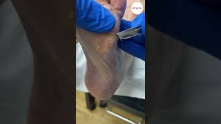 Forefoot Callus Removed by Podiatrist [upl. by Boardman]