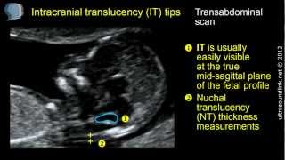 Intracranial translucency IT tips and tricks [upl. by Otrebmuh]