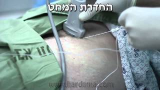 חסם עצבי פמורלי Femoral block [upl. by Dace850]