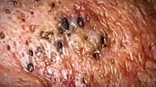 Most Satisfying Blackhead Removal 2024 [upl. by Jeminah782]