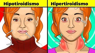 Síntomas de tiroides en mujeres hipotiroidismo e hipertiroidismo signos causas y tratamiento [upl. by Nevaeh]